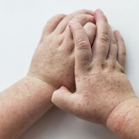 Pediatras advierten de un brote de escarlatina, una enfermedad que parece de otros tiempos pero sigue vigente 