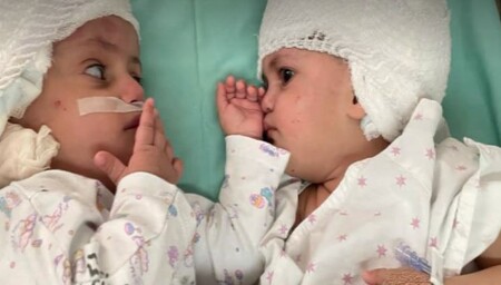 Dos hermanas siamesas unidas por la parte posterior de la cabeza son separadas con éxito en Israel