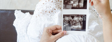 Ecografía de las 12 semanas: qué se observa en el ultrasonido del primer trimestre 