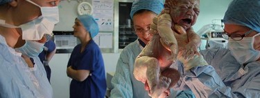 Los bebés nacidos por cesárea tendrían más riesgo de padecer alergias