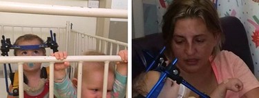 Ambas bebés sufrieron el mismo accidente de coche: la que iba en una silla a contramarcha salió ilesa, la otra sufre graves daños