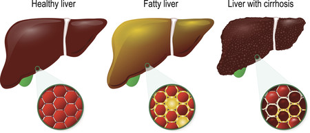 Higado Graso Y Cirrosis
