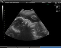 Pruebas prenatales I: ecografía