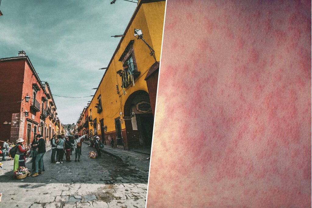 El Gobierno de México dice que la crisis del sarampión es un "problema global". Los datos dicen que es una crisis autoinfligida