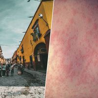 Si México cree que su crisis del sarampión es a causa de un "problema global" se equivoca: es autoinfligida