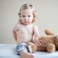 Un bebé de 20 meses no vacunado se contagia de sarampión en País Vasco