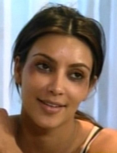 Kim Kardashian otra loca con el botox