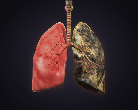 Actividad física y EPOC (Enfermedad Pulmonar Obstructiva Crónica)