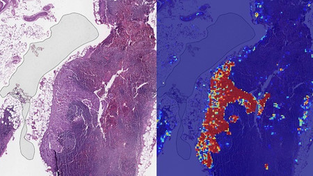 La IA de Google es mejor diagnosticando el cáncer de mama avanzado que los patólogos humanos