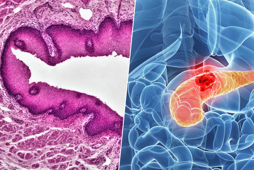 El cáncer de páncreas es un asesino silencioso. Una nueva terapia experimental ha logrado "interceptarlo" antes de que ataque