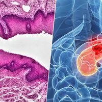 Ratones hoy, esperanza mañana: unos investigadores han logrado atacar el cáncer de páncreas antes de que se forme