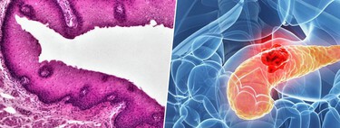 Ratones hoy, esperanza mañana: unos investigadores han logrado atacar el cáncer de páncreas antes de que se forme