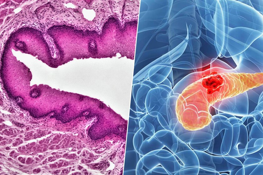 El cáncer de páncreas es un asesino silencioso: una nueva terapia experimental lo ha "interceptado" antes de que ataque