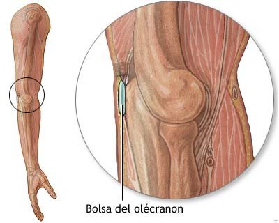 Bursitis: ¿qué es y cómo prevenirla?