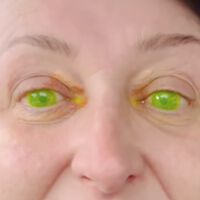 Os médicos não acreditaram no que viram: o efeito colateral assustador que fez os olhos de uma mulher brilharem no escuro 