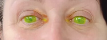 Os médicos não acreditaram no que viram: o efeito colateral assustador que fez os olhos de uma mulher brilharem no escuro 