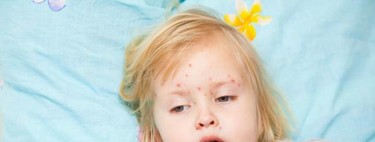 Las fiestas del sarampión, ¿no deberían prohibirse?