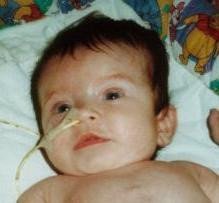 Nutrición enteral a domicilio para los niños