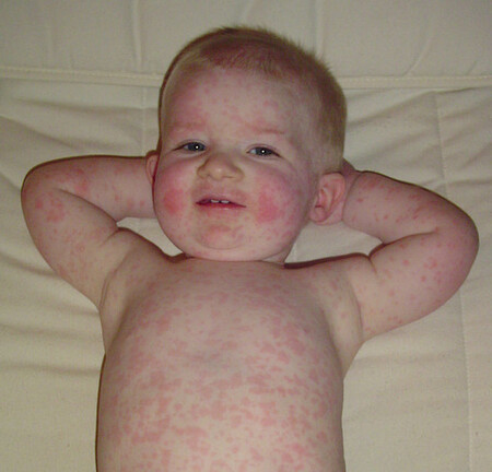 Fifth Disease Cropped