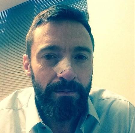 Este verano, mucha protección solar, o te pasará lo que a Hugh Jackman...