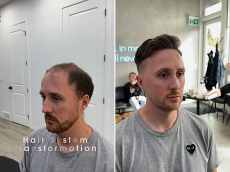 peluquin hombres solucion calvicie