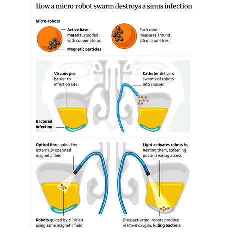 Proceso Limpieza Nariz