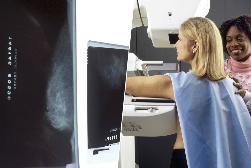 La IA ya no es una promesa en el cáncer de mama: el mayor ensayo clínico confirma que detecta más y reduce la carga del radiólogo 