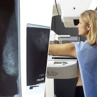 La IA ya no es una promesa en el cáncer de mama: el mayor ensayo clínico confirma que detecta más y reduce la carga del radiólogo 