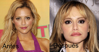 Restylane, ese asesino