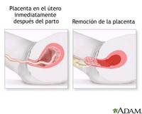 Riesgos inmediatos del postparto: inversión del útero