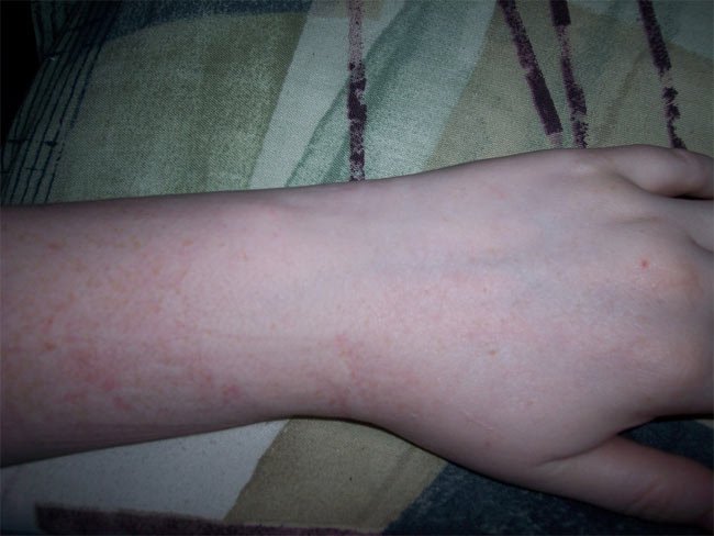 La crema hormónica de las manchas de pigmento
