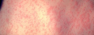 
La diferencia entre los datos del sarampión en Estados Unidos y en España está en las vacunas y se resume en una cifra: 95%