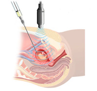 El fin de la amniocentesis, cada vez más cercano