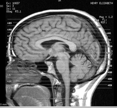 Estudio sobre el crecimiento acelerado del cerebro