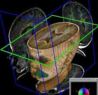 Avances para detectar lesiones en el cerebro del feto