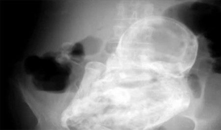 Un nuevo caso de bebé de piedra hallado tras 40 años en el abdomen de una mujer