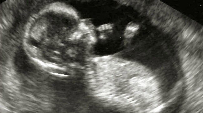 como esta el bebe alas 14 semanas de embarazo como esta el bebe alas 14 semanas de embarazo
