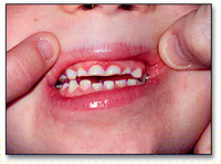 Bruxismo nocturno en los niños