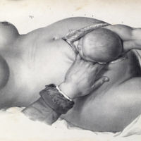 Las dos increíbles ilustraciones que muestran cómo se hacían las cesáreas cuando se operaba sin anestesia 