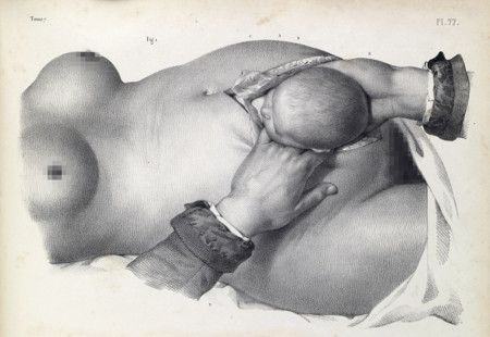Las dos increíbles ilustraciones que muestran cómo se hacían las cesáreas cuando se operaba sin anestesia