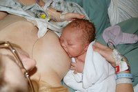 Presión inversa suavizante: una solución a la ingurgitación mamaria