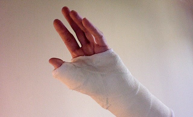 cast-injury.jpg