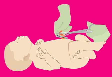 El ombligo cutáneo y probóscide en el recién nacido