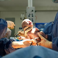 El 26 por ciento de los partos en España es por cesárea, el doble de lo recomendado por la OMS