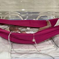 Colocar bebês prematuros em redes pode ajudá-los a sobreviver 