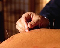 Acupuntura durante el parto