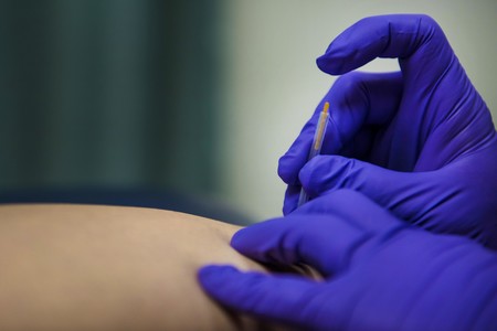 Acupuntura y punción seca: conoce las diferencias entre ellas