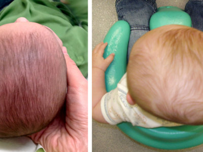Plagiocefalia: ¿Cómo prevenir y tratar la cada vez más frecuente deformidad de cabeza de los bebés?