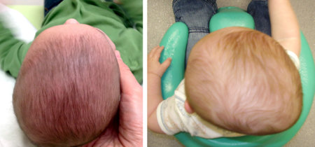 Plagiocefalia: ¿Cómo prevenir y tratar la cada vez más frecuente deformidad de cabeza de los bebés?