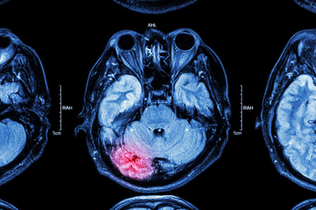 Accidentes Cerebrovasculares: una nueva y terrible epidemia